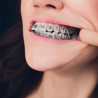 Удаление зубов при ортодонтическом лечении